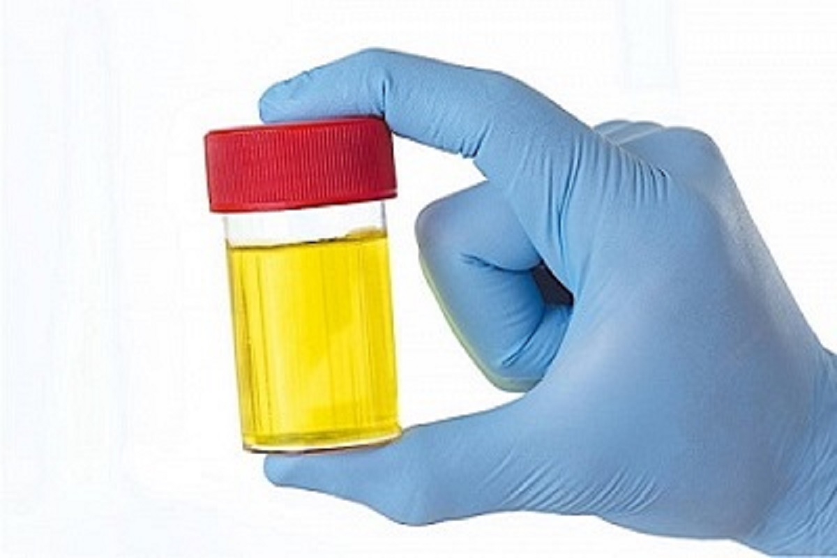 GROSS PHYSICAL EXAMINATION of URINE